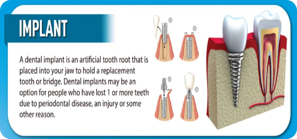 implant 1