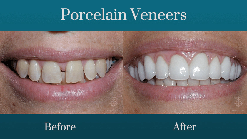 veneer 1